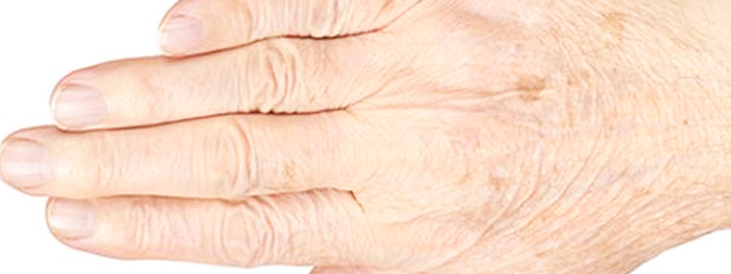 Before-Cirugía de mano