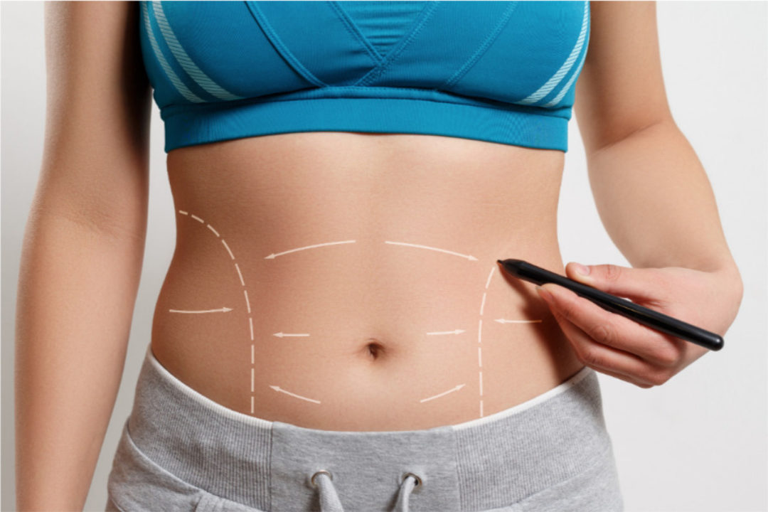 ¿Qué es y para qué se hace una abdominoplastía?