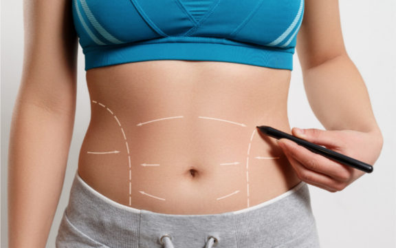 ¿Qué es y para qué se hace una abdominoplastía?