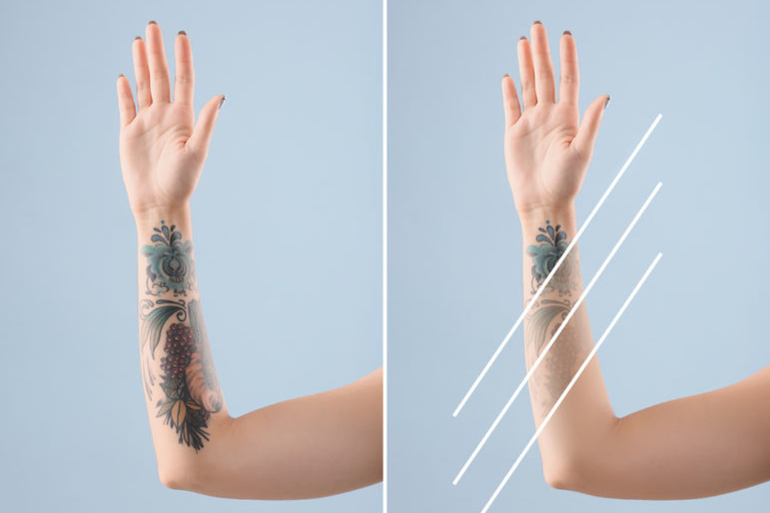 ¿Qué debes saber sobre la eliminación de tatuajes?